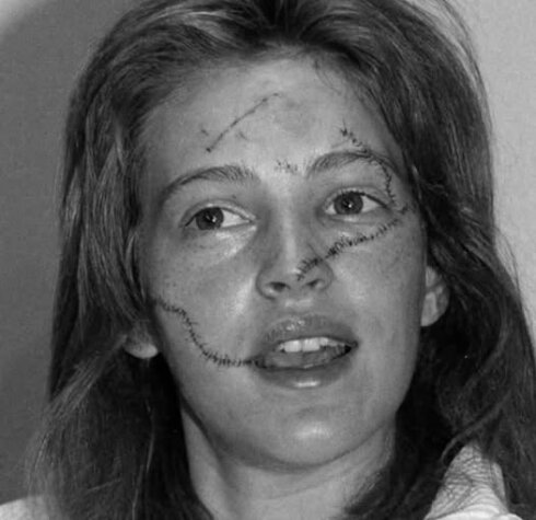 Biri onun başını tutdu, digəri isə üzünü ülgüclə kəsdi və yanaqlarında dərin S formalı yaralar buraxdı.