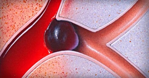 Qan laxtaları əriyəcək: qanı incələyən və qan laxtalanmasının qarşısını alan adi qidalar